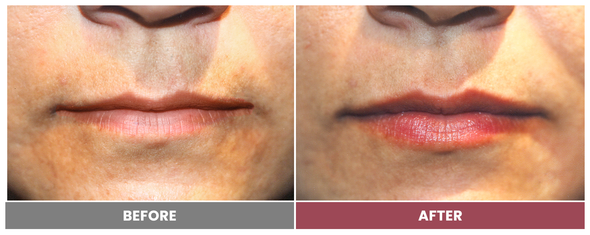 RESTYLANE - Case 2
